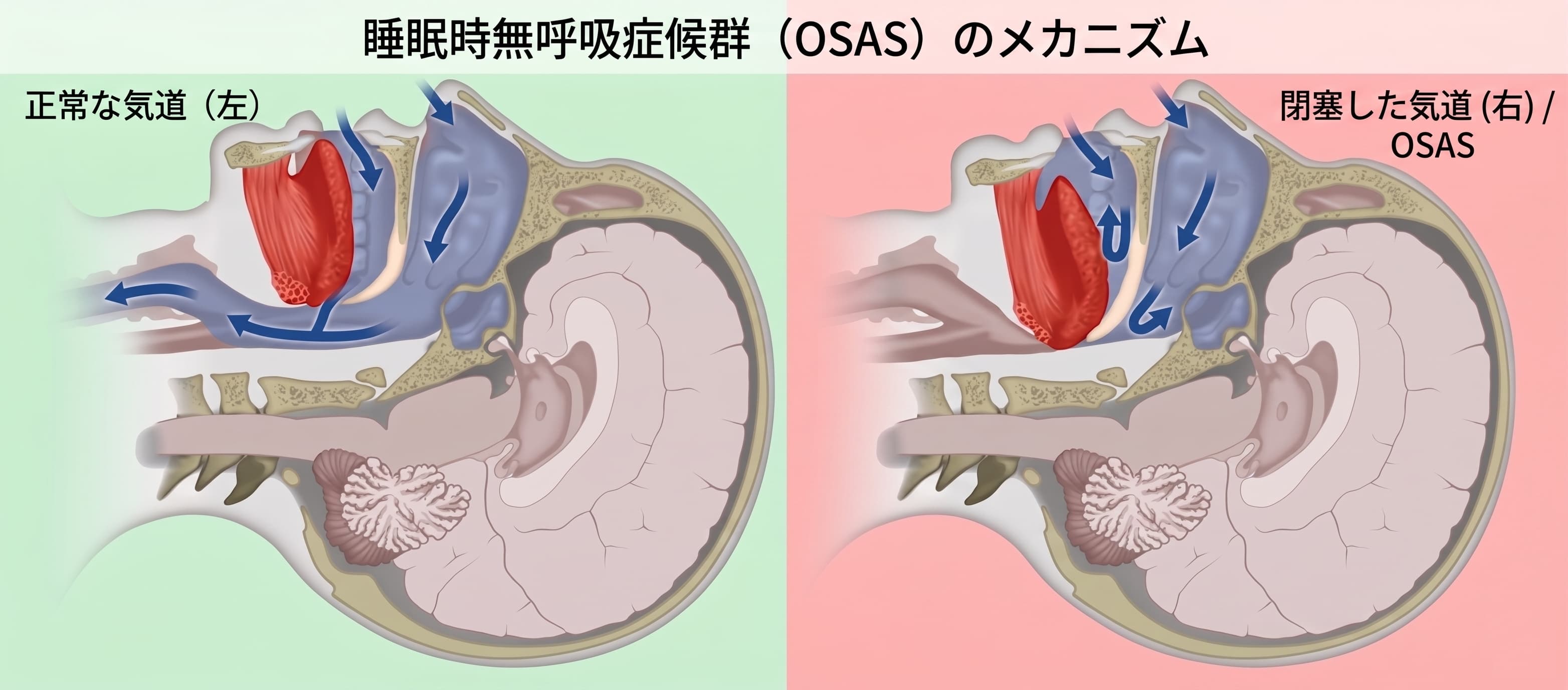 気道閉塞の3箇所（鼻腔・口蓋垂・舌根）