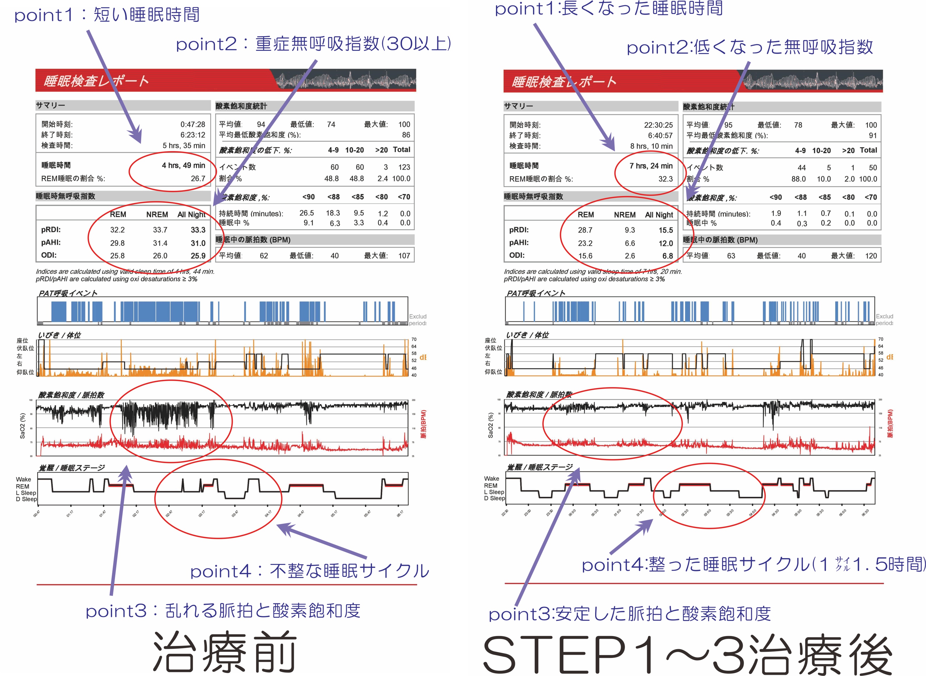 治療前後の睡眠検査データ比較