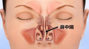 鼻中隔弯曲症 肥厚性鼻炎 あさま耳鼻咽喉科